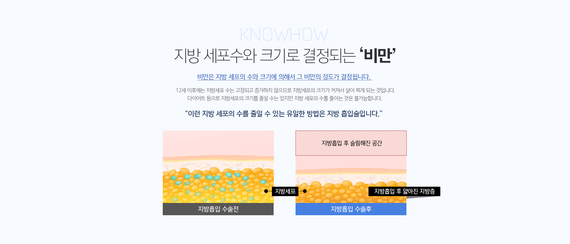 지방 세포수와 크기로 결정되는 ‘비만’
	비만은 지방 세포의 수와 크기에 의해서 그 비만의 정도가 결정됩니다. 
	12세 이후에는 지방세포 수는 고정되고 증가하지 않으므로 지방세포의 크기가 커져서 살이 찌게 되는 것입니다. 다이어트 등으로 지방세포의 크기를 줄일 수는 있지만 지방 세포의 수를 줄이는 것은 불가능합니다. 

	이런 지방 세포의 수를 줄일 수 있는 유일한 방법은 지방 흡입술입니다.
	
