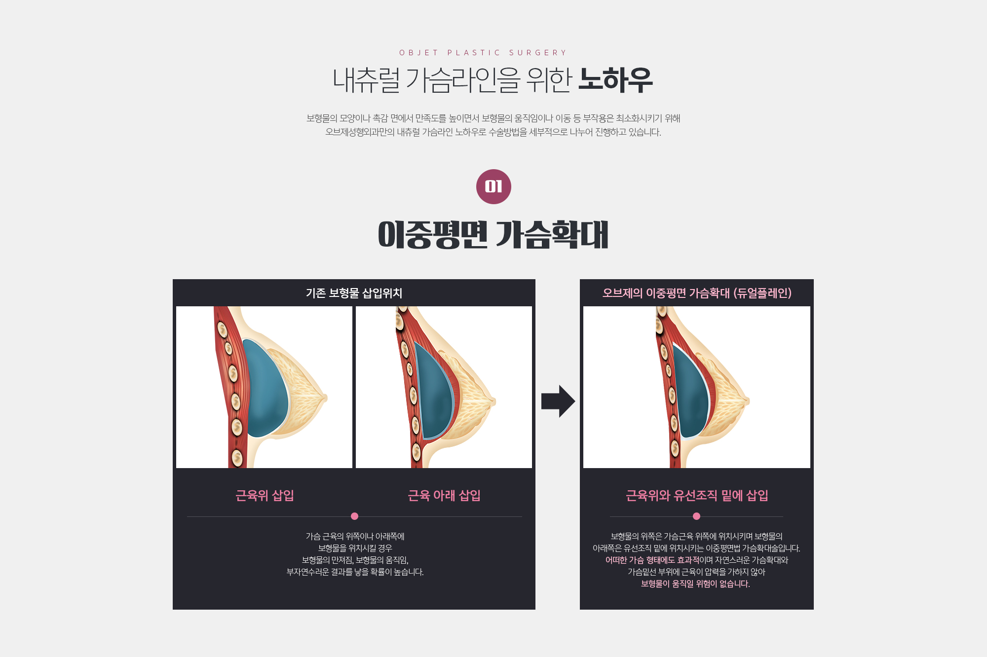 내츄럴 가슴라인을 위한 노하우
	보형물의 모양이나 촉감 면에서 만족도를 높이면서 보형물의 움직임이나 이동 등 부작용은 최소화시키기 위해 조앤신성형외과만의 내츄럴 가슴라인 노하우로 수술방법을 세부적으로 나누어 진행하고 있습니다.
	이중평면 가슴확대
	가슴 근육의 위쪽이나 아래쪽에 보형물을 위치시킬 경우 보형물의 만져짐, 보형물의 움직임, 부자연수러운 결과를 낳을 확률이 높습니다.
	조앤신의 이중평면 가슴확대 (듀얼플레인)
	보형물의 위쪽은 가슴근육 위쪽에 위치시키며 보형물의 아래쪽은 유선조직 밑에 위치시키는 이중평면법 가슴확대술입니다. 어떠한 가슴 형태에도 효과적이며 자연스러운 가슴확대와 가슴밑선 부위에 근육이 압력을 가하지 않아 보형물이 움직일 위험이 없습니다. 
	