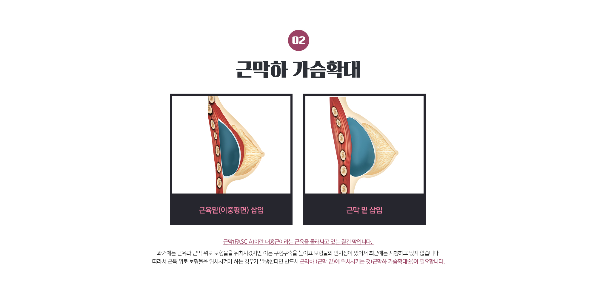근막하 가슴확대
	근막(FASCIA)이란 대흉근이라는 근육을 둘러싸고 있는 질긴 막입니다. 
	과거에는 근육과 근막 위로 보형물을 위치시켰지만 이는 구형구축을 높이고 보형물의 만져짐이 있어서 최근에는 시행하고 있지 않습니다. 따라서 근육 위로 보형물을 위치시켜야 하는 경우가 발생한다면 반드시 근막하 (근막 밑)에 위치시키는 것(근막하 가슴확대술)이 필요합니다.
	