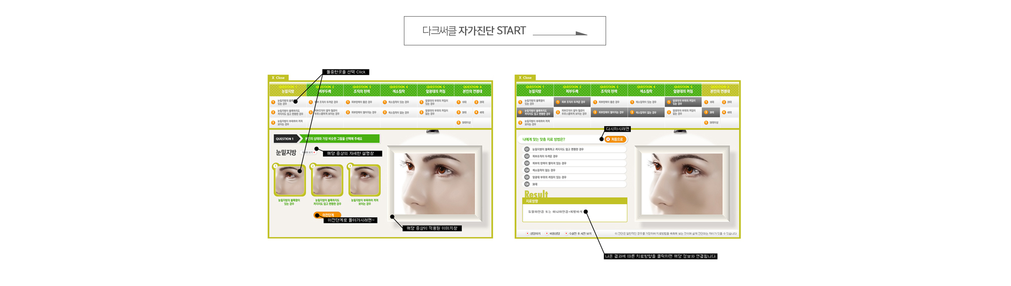 다크써클 자가진단
	나에게는 어떤 맞춤치료법이 적용될 수 있을까? 
	내게 맞는 증상에 따라 자가진단하여 수술정보와 치료법에 대한 상세한 정보를 알 수 있습니다.
	※ 정확한 맞춤치료방법은 의료진 상담 후 알 수 있습니다. 
	