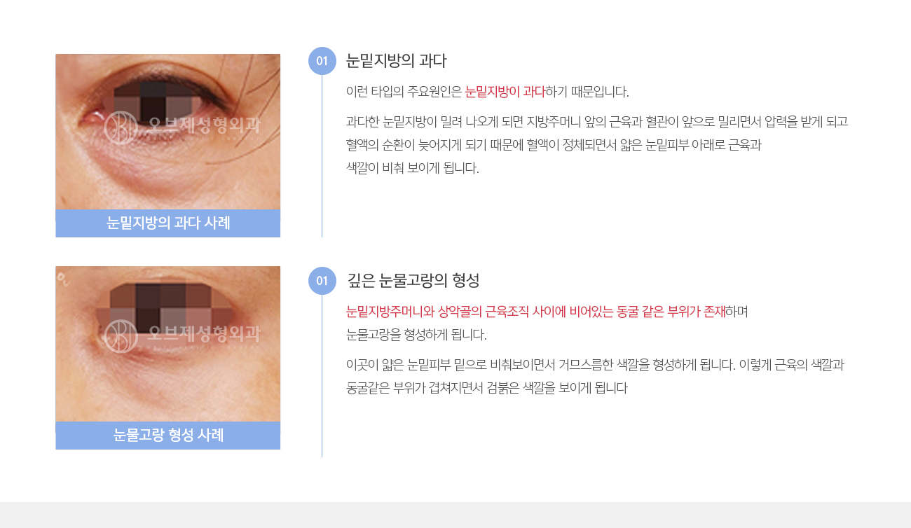 눈밑지방의 과다
				이런 타입의 주요원인은 눈밑지방이 과다하기 때문입니다. 
				과다한 눈밑지방이 밀려 나오게 되면 지방주머니 앞의 근육과 혈관이 앞으로 밀리면서 압력을 받게 되고 혈액의 순환이 늦어지게 되기 때문에 혈액이 정체되면서 얇은 눈밑피부 아래로 근육과 색깔이 비춰 보이게 됩니다.

				깊은 눈물고랑의 형성
				눈밑지방주머니와 상악골의 근육조직 사이에 비어있는 동굴 같은 부위가 존재하며 눈물고랑을 형성하게 됩니다. 
				이곳이 얇은 눈밑피부 밑으로 비춰보이면서 거므스름한 색깔을 형성하게 됩니다. 이렇게 근육의 색깔과 동굴같은 부위가 겹쳐지면서 검붉은 색깔을 보이게 됩니다
				