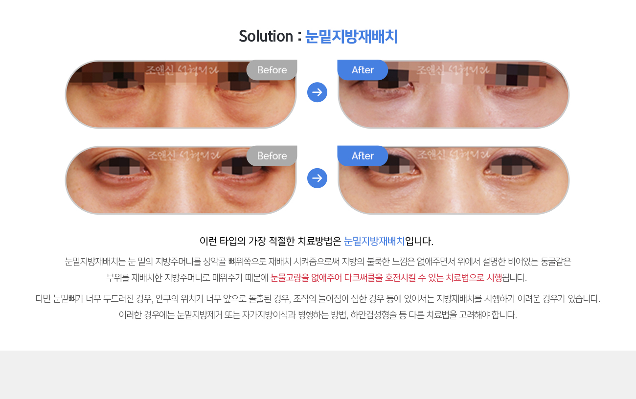 Solution : 눈밑지방재배치 
				이런 타입의 가장 적절한 치료방법은 눈밑지방재배치입니다. 

				눈밑지방재배치는 눈 밑의 지방주머니를 상악골 뼈위쪽으로 재배치 시켜줌으로써 지방의 불룩한 느낌은 없애주면서 위에서 설명한 비어있는 동굴같은 부위를 재배치한 지방주머니로 메워주기 때문에 눈물고랑을 없애주어 다크써클을 호전시킬 수 있는 치료법으로 시행됩니다. 

				다만 눈밑뼈가 너무 두드러진 경우, 안구의 위치가 너무 앞으로 돌출된 경우, 조직의 늘어짐이 심한 경우 등에 있어서는 지방재배치를 시행하기 어려운 경우가 있습니다. 이러한 경우에는 눈밑지방제거 또는 자가지방이식과 병행하는 방법, 하안검성형술 등 다른 치료법을 고려해야 합니다.
				