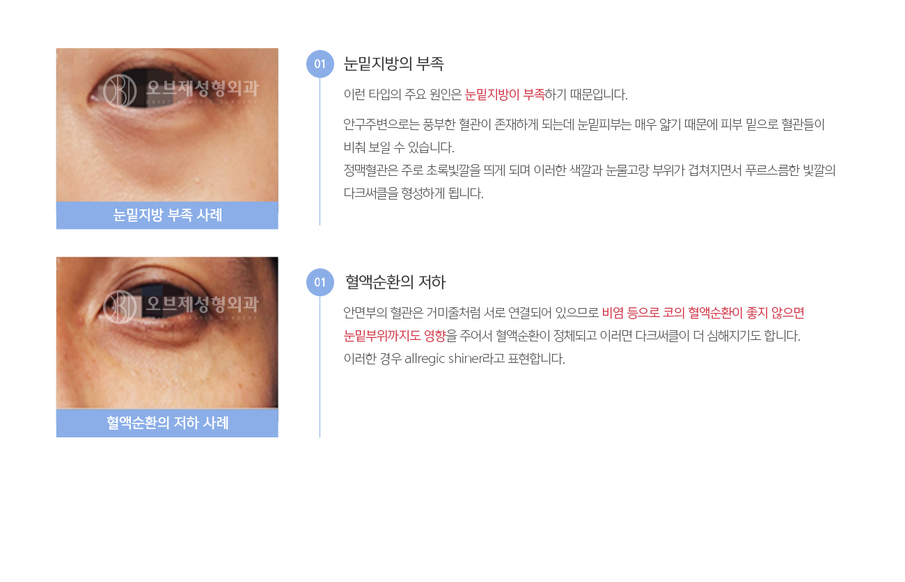 눈밑지방의 부족
				이런 타입의 주요 원인은 눈밑지방이 부족하기 때문입니다. 

				안구주변으로는 풍부한 혈관이 존재하게 되는데 눈밑피부는 매우 얇기 때문에 피부 밑으로 혈관들이 비춰 보일 수 있습니다. 정맥혈관은 주로 초록빛깔을 띄게 되며 이러한 색깔과 눈물고랑 부위가 겹쳐지면서 푸르스름한 빛깔의 다크써클을 형성하게 됩니다.
				혈액순환의 저하
				안면부의 혈관은 거미줄처럼 서로 연결되어 있으므로 비염 등으로 코의 혈액순환이 좋지 않으면 눈밑부위까지도 영향을 주어서 혈액순환이 정체되고 이러면 다크써클이 더 심해지기도 합니다. 이러한 경우 allregic shiner라고 표현합니다.
				