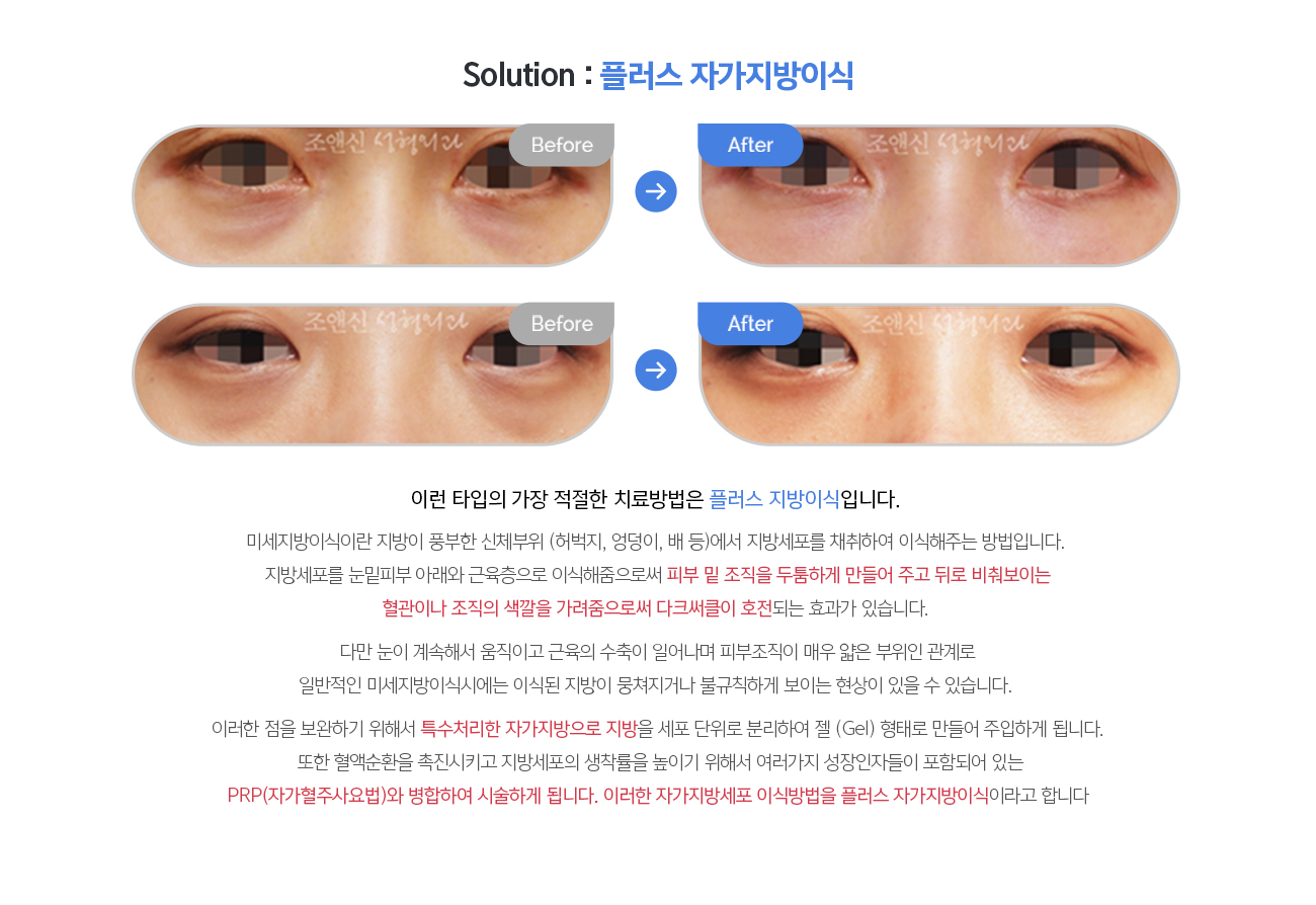 Solution : 플러스 자가지방이식
				이런 타입의 가장 적절한 치료방법은 플러스 지방이식입니다. 

				미세지방이식이란 지방이 풍부한 신체부위 (허벅지, 엉덩이, 배 등)에서 지방세포를 채취하여 이식해주는 방법입니다. 지방세포를 눈밑피부 아래와 근육층으로 이식해줌으로써 피부 밑 조직을 두툼하게 만들어 주고 뒤로 비춰보이는 혈관이나 조직의 색깔을 가려줌으로써 다크써클이 호전되는 효과가 있습니다. 

				다만 눈이 계속해서 움직이고 근육의 수축이 일어나며 피부조직이 매우 얇은 부위인 관계로 일반적인 미세지방이식시에는 이식된 지방이 뭉쳐지거나 불규칙하게 보이는 현상이 있을 수 있습니다. 

				이러한 점을 보완하기 위해서 특수처리한 자가지방으로 지방을 세포 단위로 분리하여 젤 (Gel) 형태로 만들어 주입하게 됩니다. 또한 혈액순환을 촉진시키고 지방세포의 생착률을 높이기 위해서 여러가지 성장인자들이 포함되어 있는 PRP(자가혈주사요법)와 병합하여 시술하게 됩니다. 이러한 자가지방세포 이식방법을 플러스 자가지방이식이라고 합니다
				