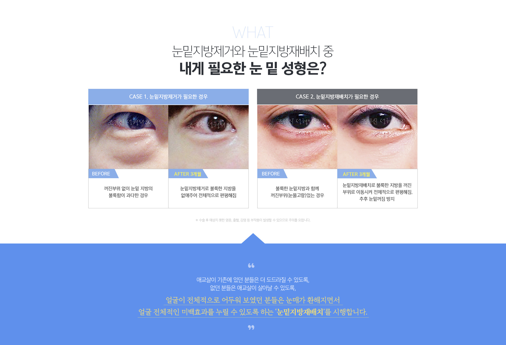 생기 넘치고 어려 보이는 눈밑성형, 어떤 분들에게 필요할까요? 
	1. 눈밑피부의 처짐과 주름은 심하지 않아 피부 절제가 필요 없는 분
	2. 눈 밑의 눈물고랑이 깊으신 분 
	3. 하안검성형술로 지방을 제거하였으나 지방주머니가 재발한 분 
	4. 지방제거술만으로는 눈 밑이 꺼져 보일 수 있는 분
	5. 대인관계가 많이 수술자국을 보이기 꺼려지고 빠른 회복을 원하는 분 
	6. 개개인에 맞춘 눈밑 성형 결과를 원하시는 분 
	
