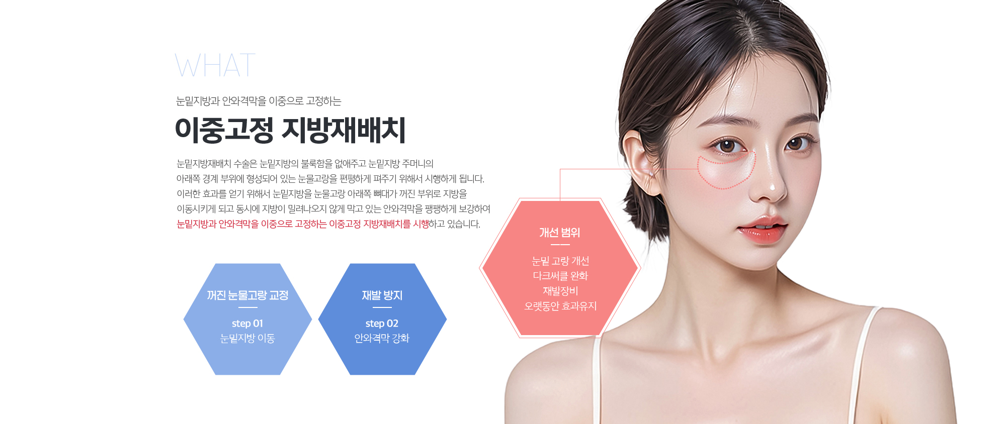 이중고정 지방재배치 
	눈밑지방재배치 수술은 눈밑지방의 불룩함을 없애주고 눈밑지방 주머니의 아래쪽 경계 부위에 형성되어 있는 눈물고랑을 편평하게 펴주기 위해서 시행하게 됩니다. 

	이러한 효과를 얻기 위해서 눈밑지방을 눈물고랑 아래쪽 뼈대가 꺼진 부위로 지방을 이동시키게 되고 동시에 지방이 밀려나오지 않게 막고 있는 안와격막을 팽팽하게 보강하여 눈밑지방과 안와격막을 이중으로 고정하는 이중고종 지방재배치를 시행하고 있습니다.
	