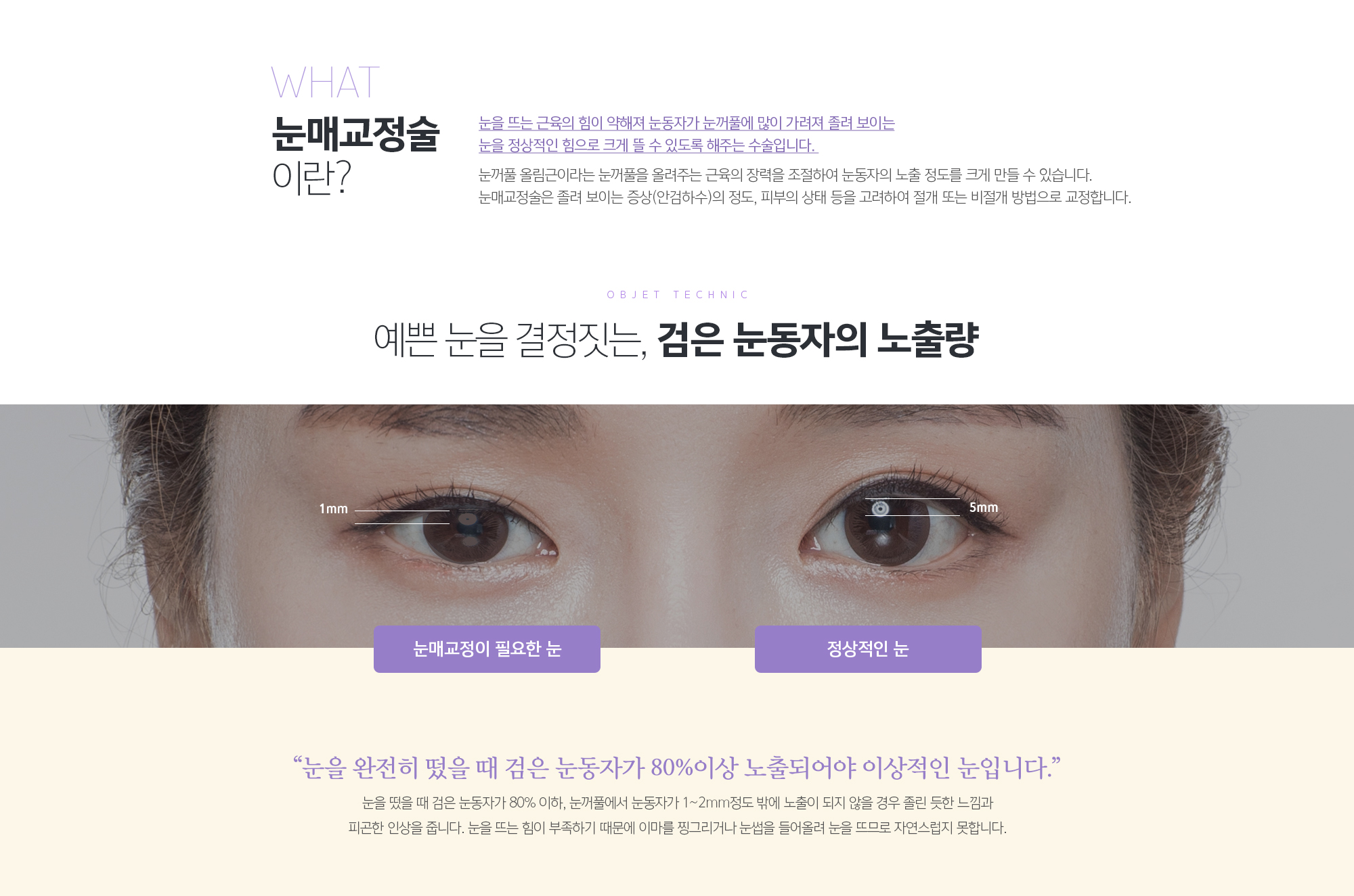 눈매교정술 이란?
	눈을 뜨는 근육의 힘이 약해져 눈동자가 눈꺼풀에 많이 가려져 졸려 보이는 눈을 정상적인 힘으로 크게 뜰 수 있도록 해주는 수술입니다. 
	눈꺼풀 올림근이라는 눈꺼풀을 올려주는 근육의 장력을 조절하여 눈동자의 노출 정도를 크게 만들 수 있습니다. 눈매교정술은 졸려 보이는 증상(안검하수)의 정도, 피부의 상태 등을 고려하여 절개 또는 비절개 방법으로 교정합니다. 
	