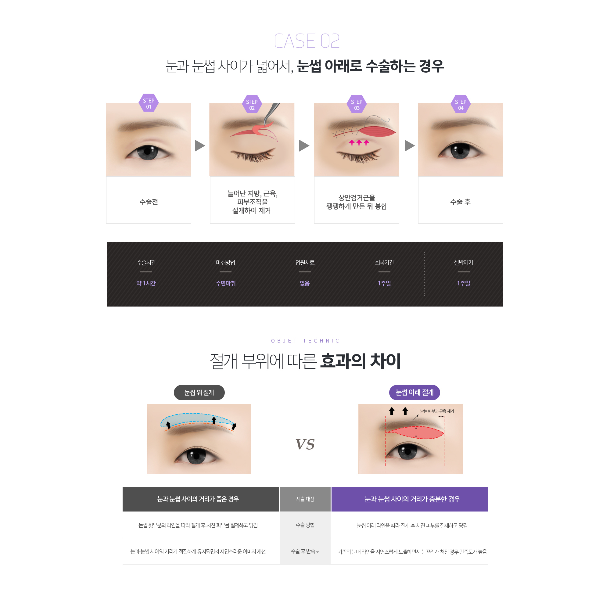절개 부위에 따른 효과의 차이 눈썹 위 절개VS눈썹 아래 절개