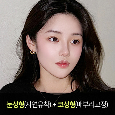 자연유착 쌍꺼풀