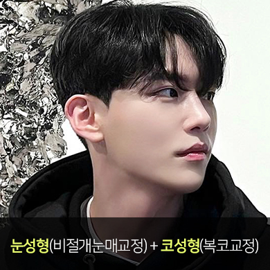 비절개 눈매교정