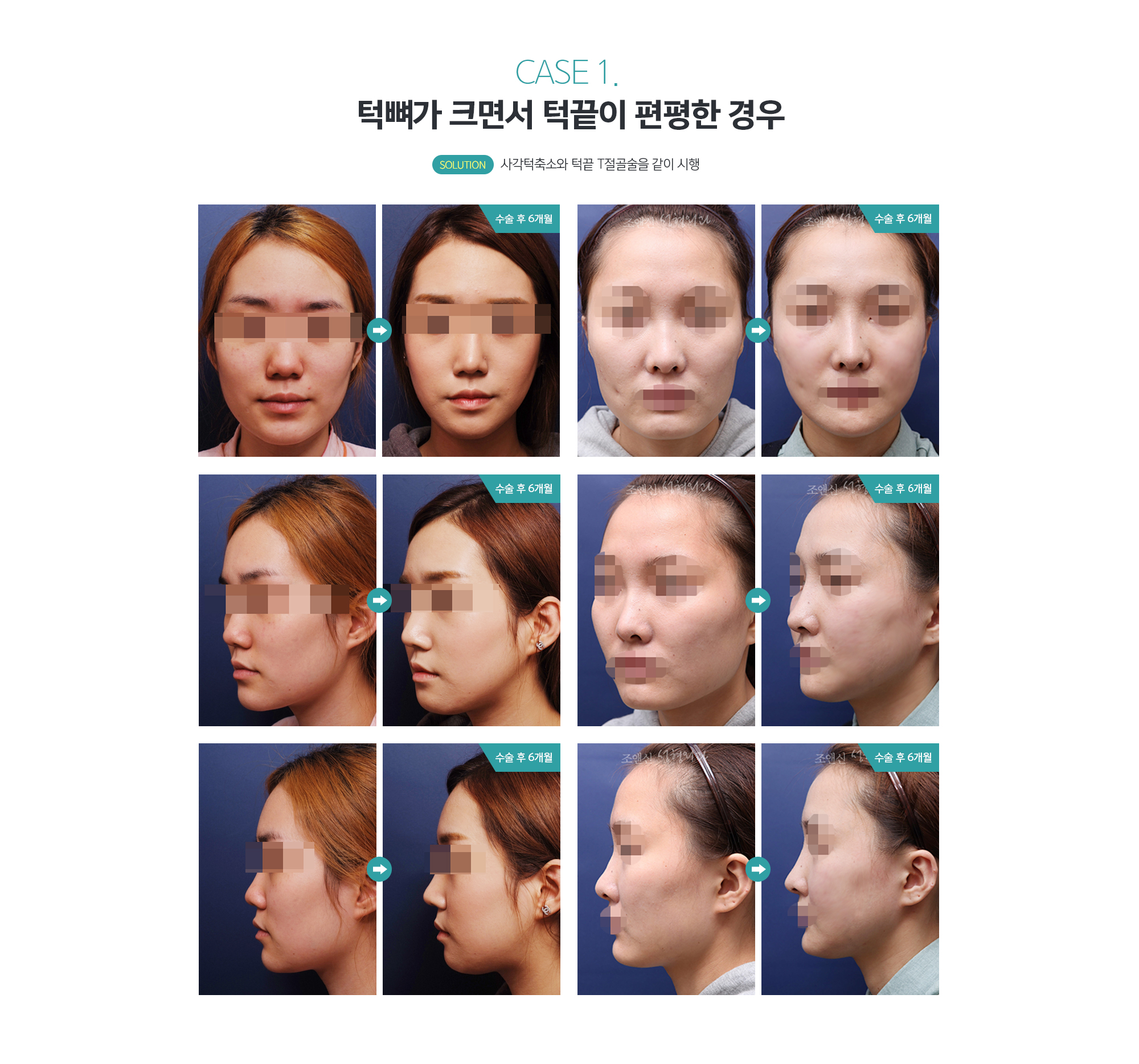 CASE 2. 턱뼈는 별로 크지 않으면서 턱끝에 2개의 포인트가 있는 경우 Solution 턱끝 T절골술만 시행