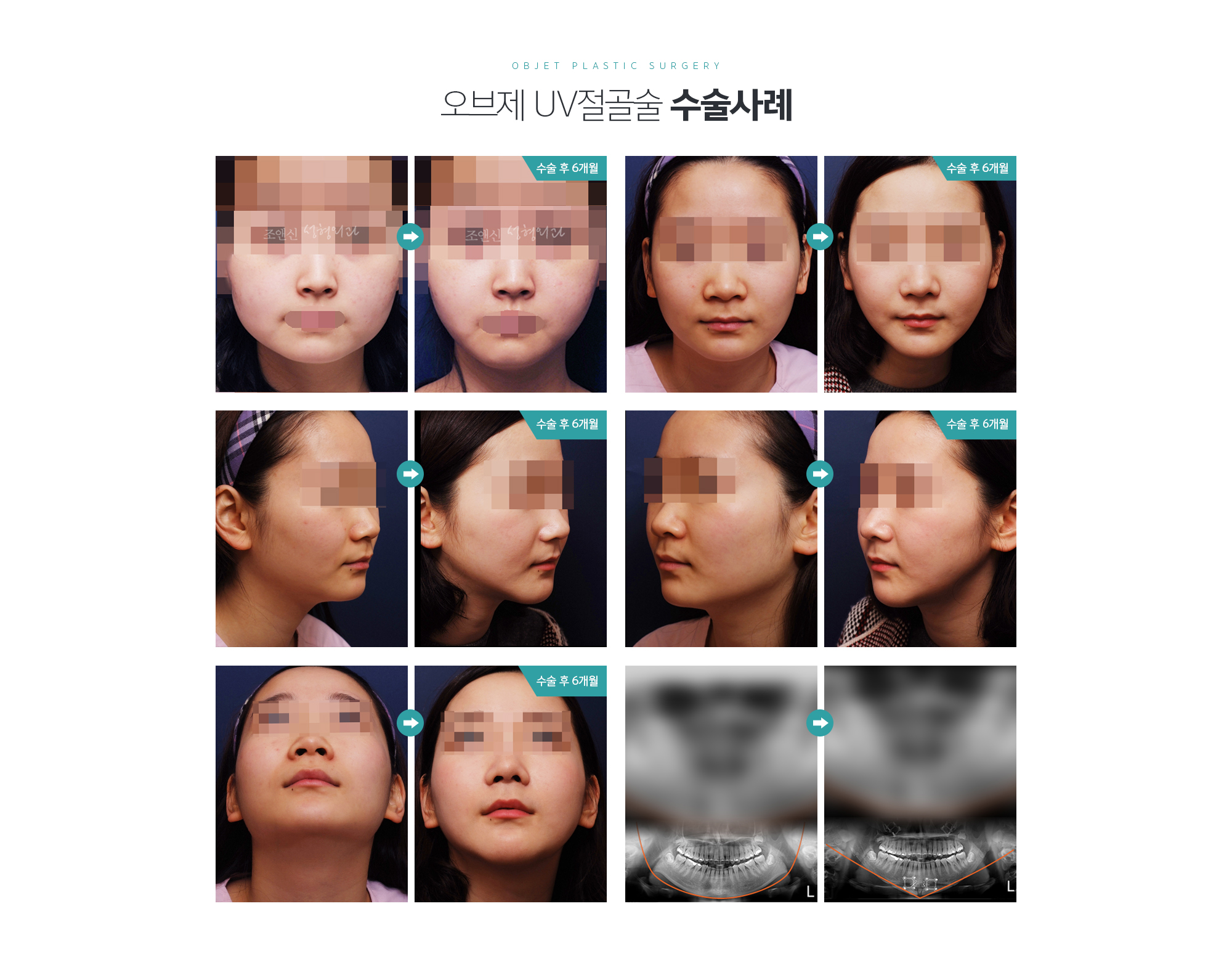 UV절골술 수술방법
	턱끝의 가운데 뼈를 마름모꼴의 형태로 절골하고 이를 회전시켜 턱끝이 길어질 수 있도록 배열하고 이를 받침대 삼아서 양측의 턱끝 뼈를 가운데로 모아서 고정해 줍니다. 
	턱끝의 상하길이가 길어지면서 좌우폭이 동시에 좁아져 턱끝의 슬림한 라인이 더 잘 살아나게 됩니다. 사각턱이 있는 경우에는 돌려깎기나 사각턱절제술과 병행하여 주는 것이 좋습니다.
	