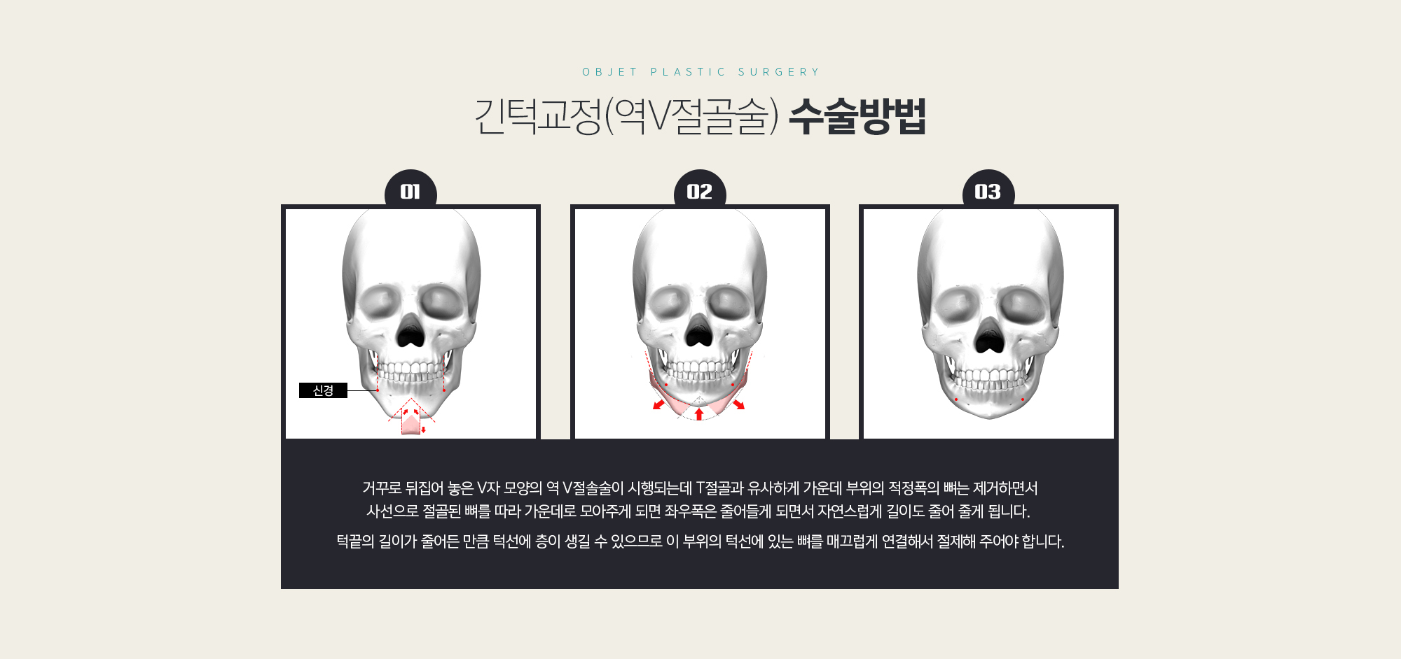 긴턱교정(역V절골술) 수술방법
	거꾸로 뒤집어 놓은 V자 모양의 역 V절솔술이 시행되는데 T절골과 유사하게 가운데 부위의 적정폭의 뼈는 제거하면서 사선으로 절골된 뼈를 따라 가운데로 모아주게 되면 좌우폭은 줄어들게 되면서 자연스럽게 길이도 줄어 줄게 됩니다. 

	턱끝의 길이가 줄어든 만큼 턱선에 층이 생길 수 있으므로 이 부위의 턱선에 있는 뼈를 매끄럽게 연결해서 절제해 주어야 합니다.
	