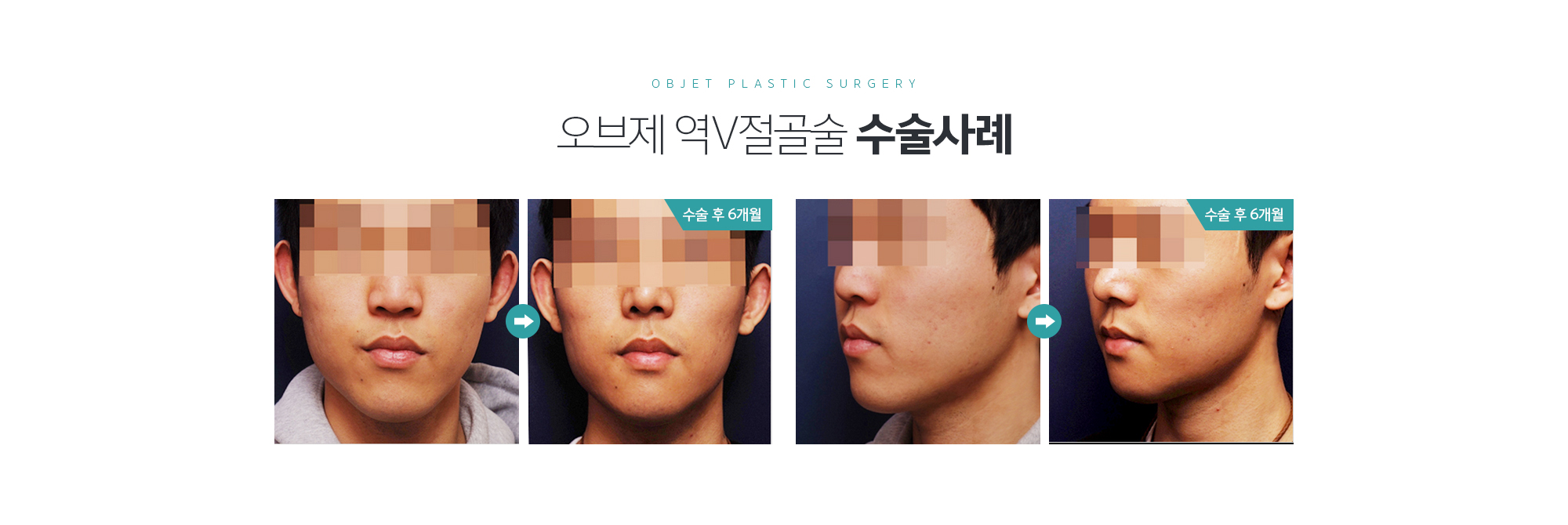 조앤신 UV절골술 수술사례