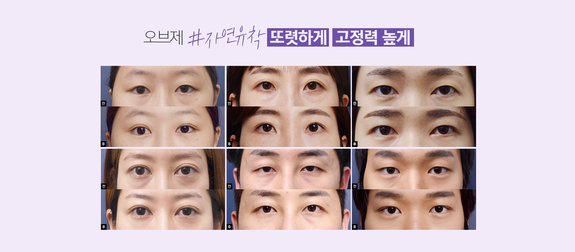 일반 눈성형(매몰법) VS 조앤신 자연유착법