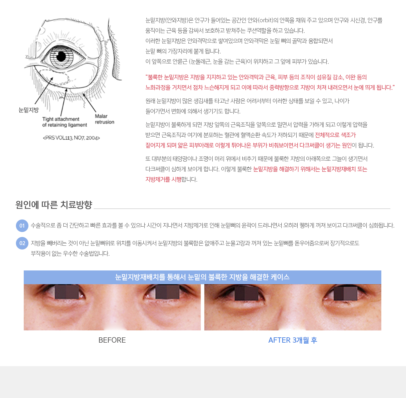 눈밑지방(안와지방)은 안구가 들어있는 공간인 안와(orbit)의 안쪽을 채워 주고 있으며 안구와 시신경, 안구를 움직이는 근육 등을 감싸서 보호하고 받쳐주는 쿠션역할을 하고 있습니다. 
				이러한 눈밑지방은 안와격막으로 쌓여있으며 안와격막은 눈밑 뼈의 골막과 융합되면서 눈밑 뼈의 가장자리에 붙게 됩니다. 이 앞쪽으로 안륜근 (눈둘레근, 눈을 감는 근육)이 위치하고 그 앞에 피부가 있습니다.

				“불룩한 눈밑지방은 지방을 지지하고 있는 안와격막과 근육, 피부 등의 조직이 섬유질 감소, 이완 등의 노화과정을 거치면서 점차 느슨해지게 되고 이에 따라서 중력방향으로 지방이 처져 내려오면서 눈에 띄게 됩니다.” 

				원래 눈밑지방이 많은 생김새를 타고난 사람은 어려서부터 이러한 상태를 보일 수 있고, 나이가 들어가면서 변화에 의해서 생기기도 합니다. 

				눈밑지방이 불룩하게 되면 지방 앞쪽의 근육조직을 앞쪽으로 밀면서 압력을 가하게 되고 이렇게 압력을 받으면 근육조직과 여기에 분포하는 혈관에 혈액순환 속도가 저하되기 때문에 전체적으로 색조가 짙어지게 되며 얇은 피부아래로 이렇게 튀어나온 부위가 비춰보이면서 다크써클이 생기는 원인이 됩니다. 

				또 대부분의 태양광이나 조명이 머리 위에서 비추기 때문에 불룩한 지방의 아래쪽으로 그늘이 생기면서 다크써클이 심하게 보이게 합니다. 이렇게 불룩한 눈밑지방을 해결하기 위해서는 눈밑지방재배치 또는 지방제거를 시행합니다.
				