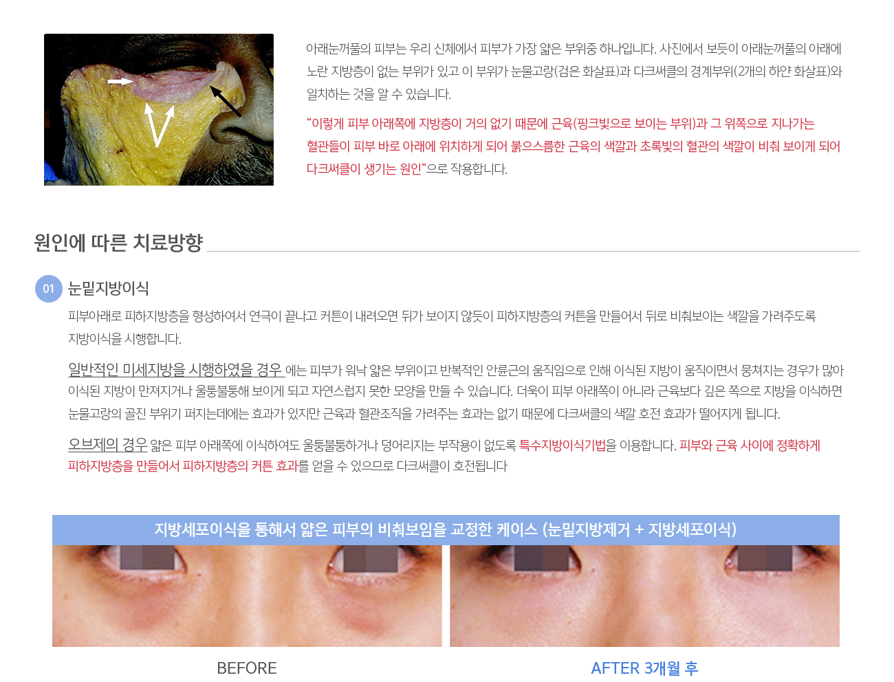 아래눈꺼풀의 피부는 우리 신체에서 피부가 가장 얇은 부위중 하나입니다. 사진에서 보듯이 아래눈꺼풀의 아래에 노란 지방층이 없는 부위가 있고 이 부위가 눈물고랑(검은 화살표)과 다크써클의 경계부위(2개의 하얀 화살표)와 일치하는 것을 알 수 있습니다. 

				“이렇게 피부 아래쪽에 지방층이 거의 없기 때문에 근육(핑크빛으로 보이는 부위)과 그 위쪽으로 지나가는 혈관들이 피부 바로 아래에 위치하게 되어 붉으스름한 근육의 색깔과 초록빛의 혈관의 색깔이 비춰 보이게 되어 다크써클이 생기는 원인”으로 작용합니다.
				