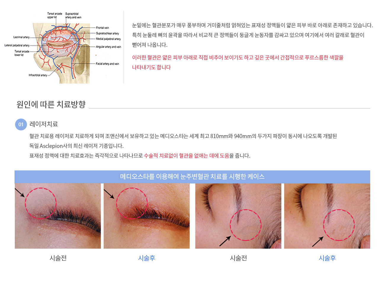 눈밑에는 혈관분포가 매우 풍부하며 거미줄처럼 얽혀있는 표재성 정맥들이 얇은 피부 바로 아래로 존재하고 있습니다. 특히 눈둘레 뼈의 윤곽을 따라서 비교적 큰 정맥들이 둥글게 눈동자를 감싸고 있으며 여기에서 여러 갈래로 혈관이 뻗어져 나옵니다. 이러한 혈관은 얇은 피부 아래로 직접 비추어 보이기도 하고 깊은 곳에서 간접적으로 푸르스름한 색깔을 나타내기도 합니다
				