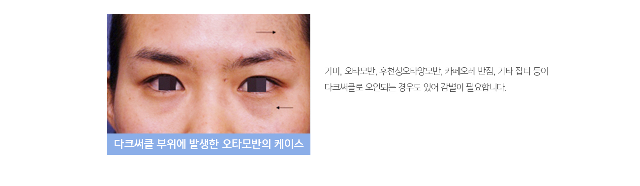 기미, 오타모반, 후천성오타양모반, 카페오레 반점, 기타 잡티 등이 다크써클로 오인되는 경우도 있어 감별이 필요합니다.